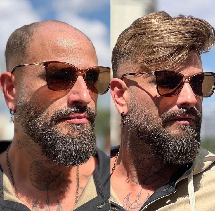 بهترین کاشت مو طبیعی در شیراز با خط رویش حرفه‌ای