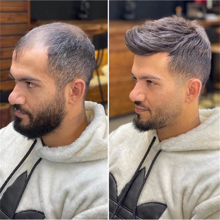 کاشت مو مردانه در شیراز با جدیدترین متدها